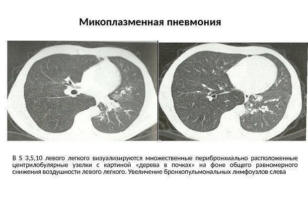 Микоплазма пневмония: симптомы и лечение
