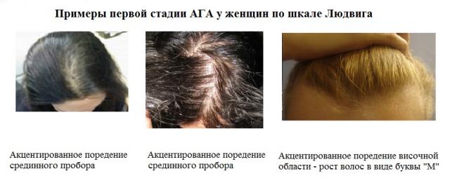 Алопеция (облысение, выпадение волос). причины, виды, лечение и профилактика патологии