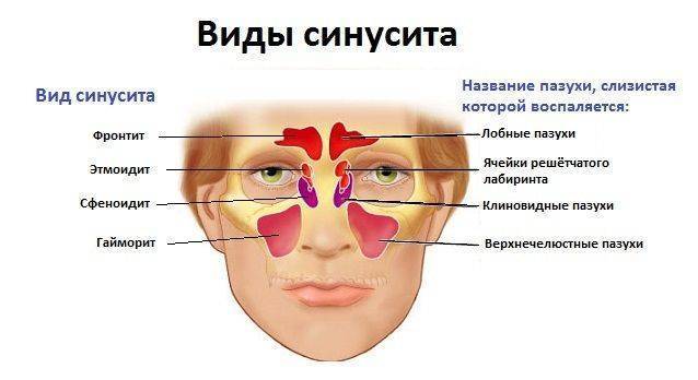 Симптомы гайморита у взрослых: