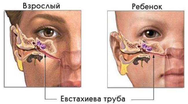 Что делать, если продуло и болит ухо, симптомы и лечение простуды дома