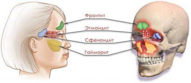 Сфеноидит: симптомы и лечение у взрослых и детей
