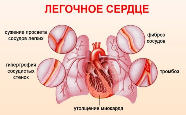 Неполная блокада правой ножки пучка гиса - экг