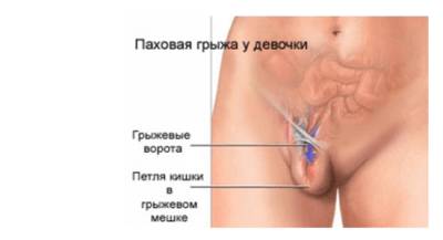 Диагностика и лечение паховой грыжи у женщин