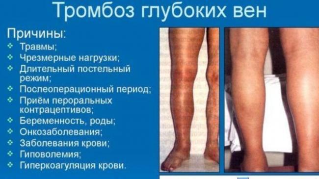 Образ жизни и диета при тромбозе и тромбофлебите: как ускорить выздоровление и сделать его вкусным?