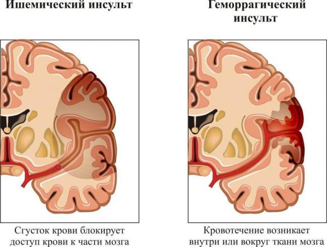 Блокада правой ножки пучка гиса: причины, основные симптомы, методы диагностики, лечение и профилактика