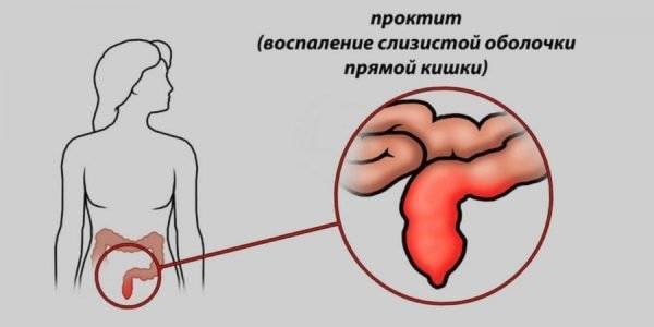 Киста копчика: симптомы и лечение у мужчин, как лечить без операции в домашних условиях