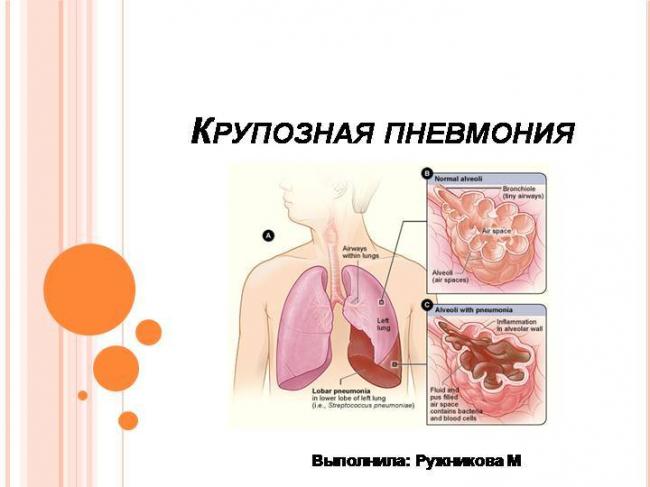 Симптомы, стадии и лечение крупозной пневмонии у взрослых