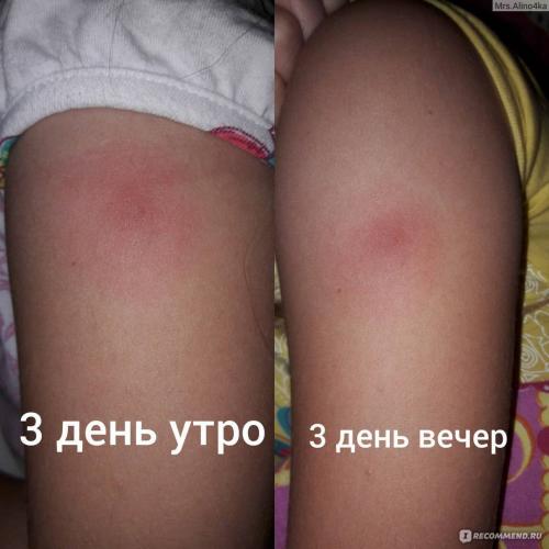 Нет рубца от бцж