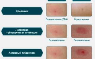 Какая должна быть реакция на манту у ребенка: норма и отклонения. как правильно измерить папулу
