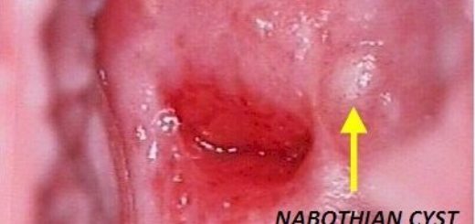 Цервицит: симптомы и лечение заболевания