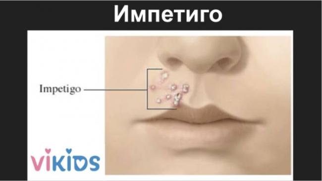 Как понять, бактериальная или вирусная инфекция, по общему анализу крови