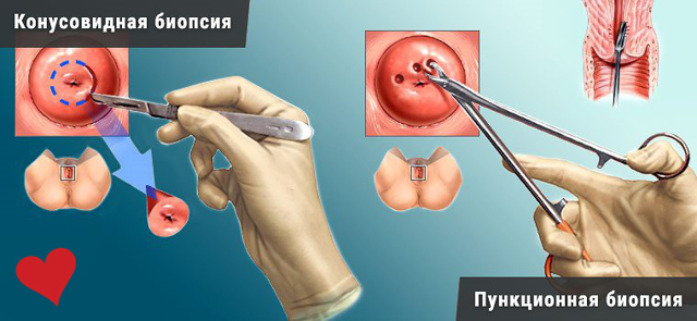 Цервицит