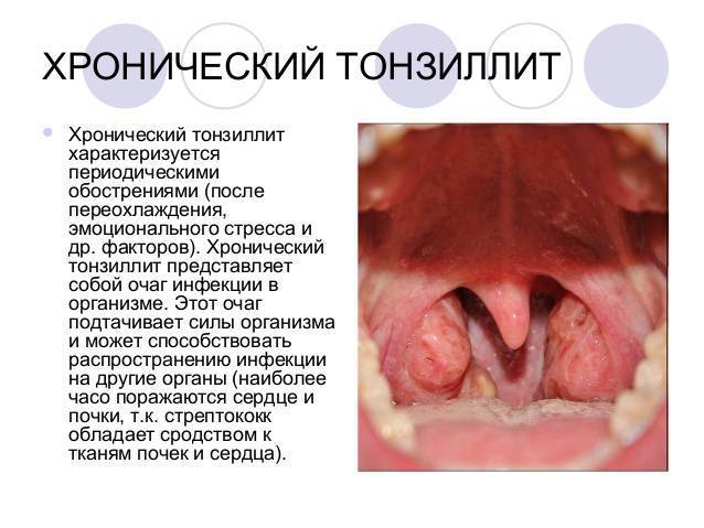 Лечение обострения хронического тонзиллита без температуры