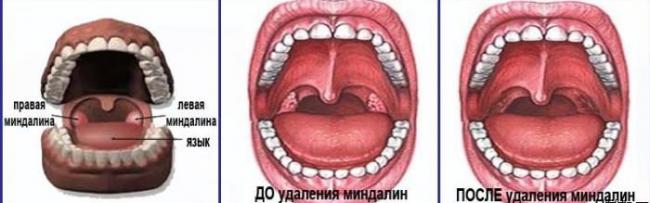 Тонзиллит у взрослых: как лечить и предупредить?