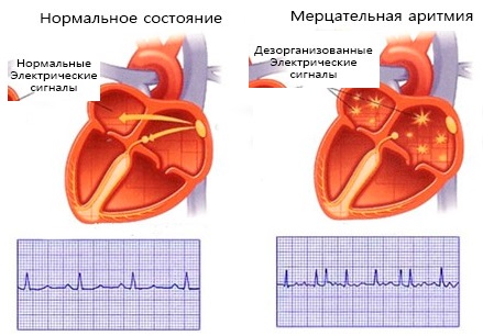 Лечение аритмии сердца