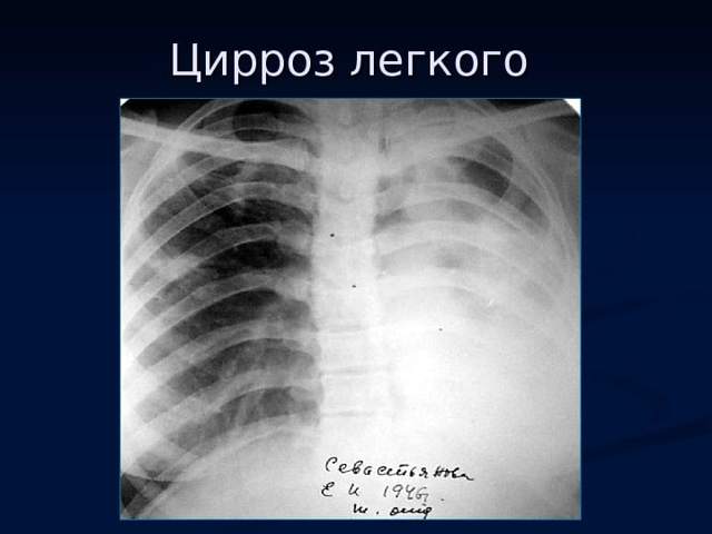 Читать книгу очищение и восстановление организма народными средствами после туберкулеза алевтины корзуновой : онлайн чтение - страница 9