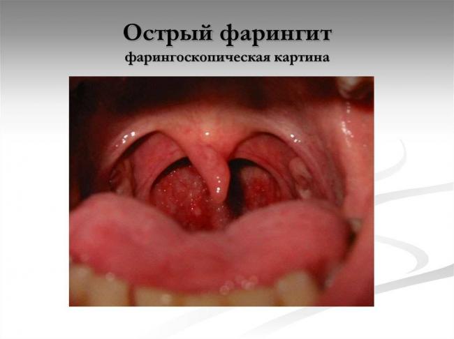Острый фарингит