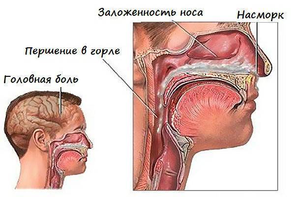 Гайморит – симптомы у взрослых, лечение в домашних условиях