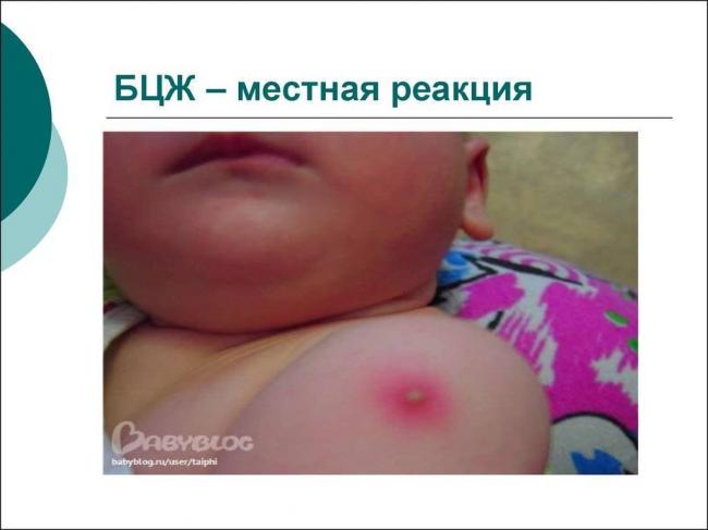 Как избежать аллергии на диаскинтест