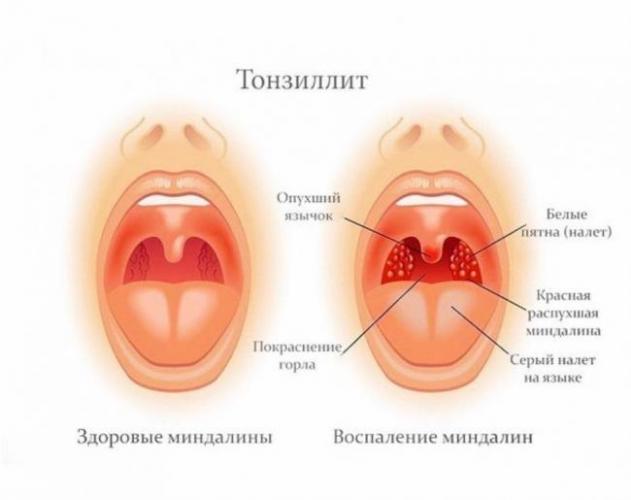 Хронический тонзиллит у взрослых: причины, формы течения, жалобы, диагностика, лечение и профилактика.