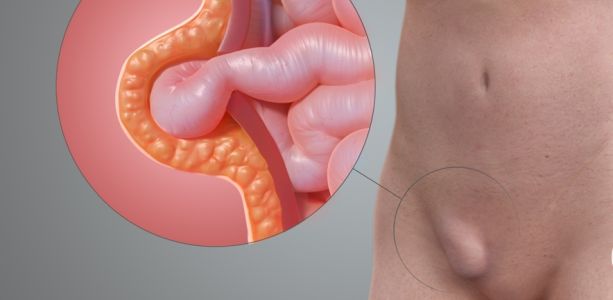 Паховая грыжа – симптомы, лечение, удаление, операция, профилактика