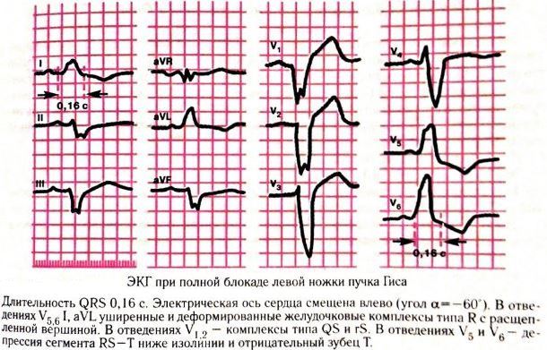 Неполная блокада правой ножки пучка гиса
