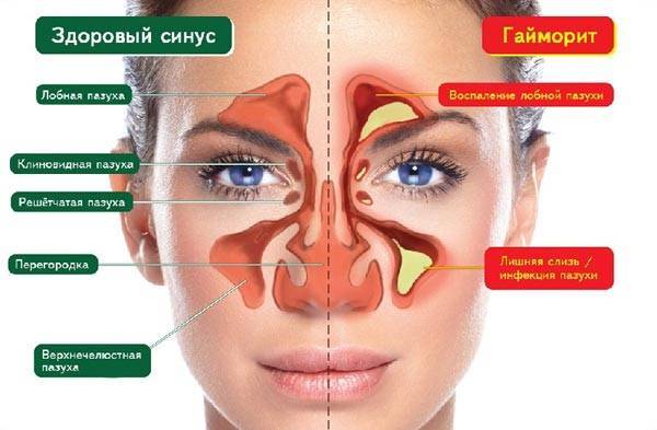 Антибиотики при насморке у взрослых и детей: какие лучше выбрать и как лечить