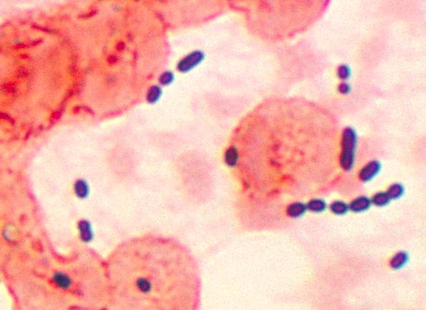 Enterococcus faecalis (энтерококк фекальный) в мазке у женщин
