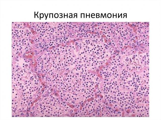 Пневмония. причины, симптомы, современная диагностика и эффективное лечение болезни.