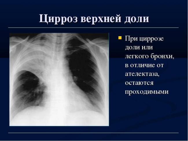 Туберкулез: симптомы и первые признаки в начальной стадии