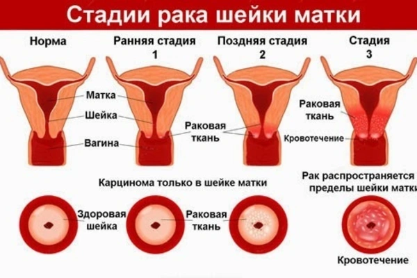Заболевания шейки матки