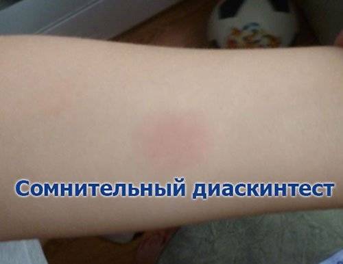 Диаскинтест при орви последствия