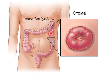 Питание при стоме прямой кишки
