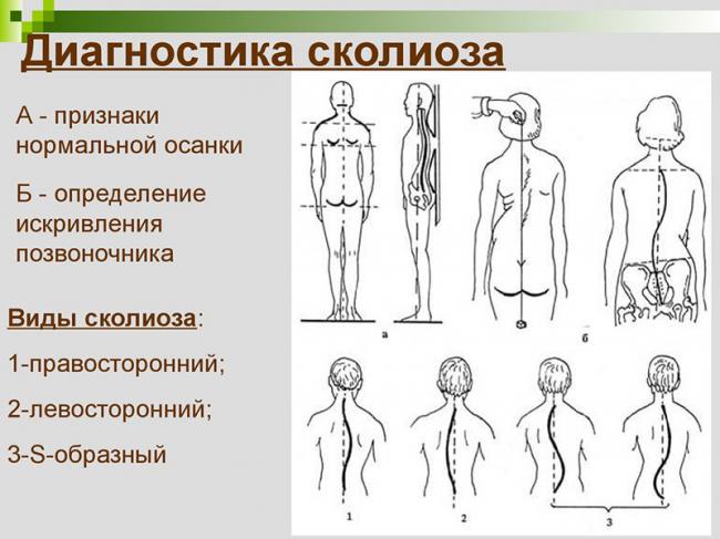 Упражнения при правостороннем сколиозе грудного отдела позвоночника 2 степени