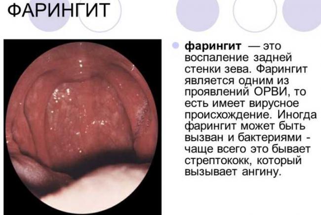 Боковой фарингит (острый и хронический): симптомы и лечение