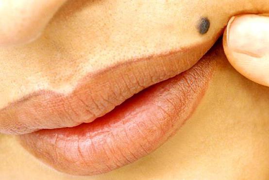 Опасные родинки: 6 признаков меланомы