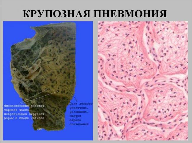 Крупозная пневмония – симптомы, лечение