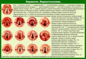 Выявляем признаки трахеита у взрослых