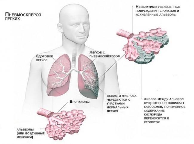 Метатуберкулезные изменения в легких — что это такое? лечение