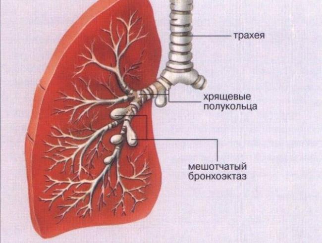 Очаговый туберкулез легких