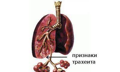 Лечение ларинготрахеита у взрослых препараты