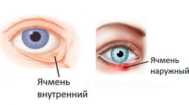 Как правильно лечить ячмень во время беременности