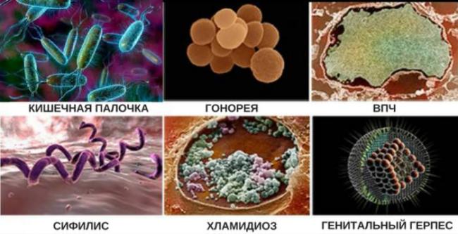 Подробное объяснение цервицита (воспаление шейки матки): что это такое, причины, симптомы и признаки, лечение