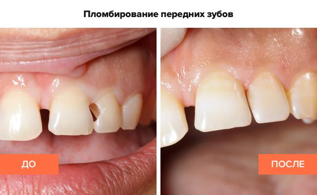 Пломбирование зубов