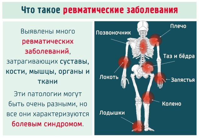 Ревматизм (острая ревматическая лихорадка)