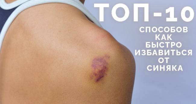 Ушиб ноги лечение гематома