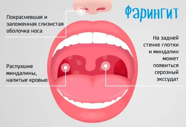 Хронический и острый гранулезный фарингит: почему появляется, как распознать и чем лечить