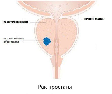 Аналог таблеток флутамид