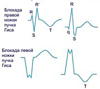 Неполная блокада правой ножки пучка гиса - как лечить?