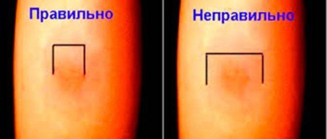 Как правильно измеряют манту у детей?